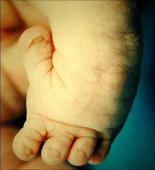 Diastrophic Dysplasia Pediatrics Orthobullets